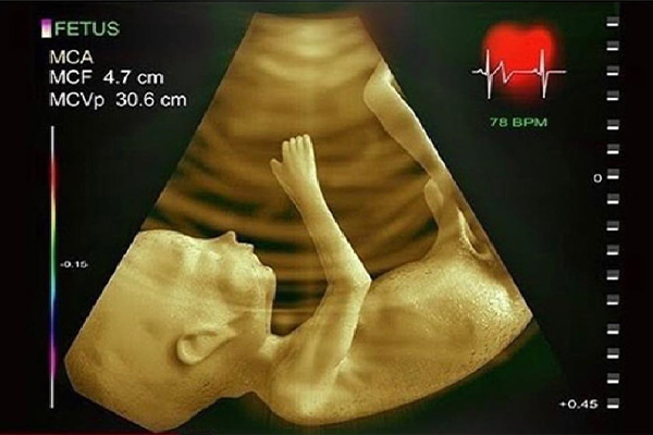 اکوکاردیوگرافی پیشرفته قلب جنین